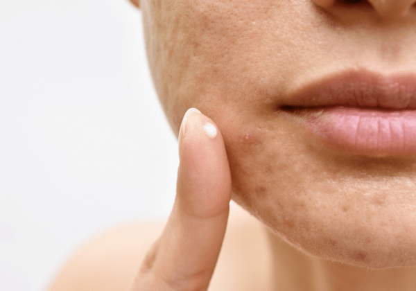 6 produits naturels pour lutter contre l'acné