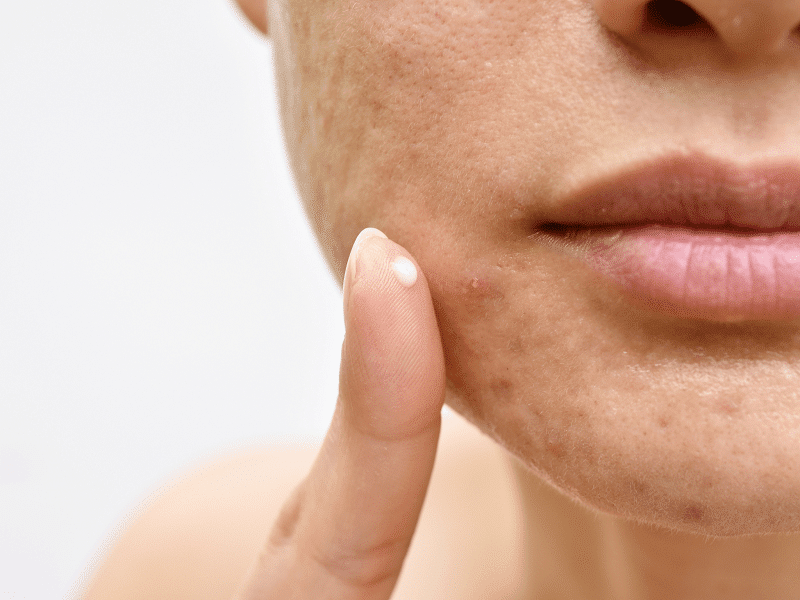 6 produits naturels pour lutter contre l'acné